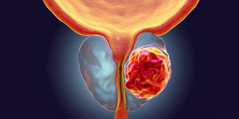 Lee más sobre el artículo Cáncer de Próstata: Claves para Prevención y Diagnóstico Precoz | SAV