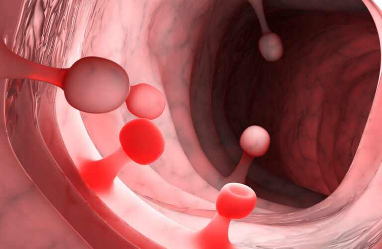 Lee más sobre el artículo Alerta: 42% con pólipos en jornada de cáncer colon SAV
