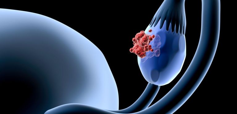 Lee más sobre el artículo Conoce los síntomas, diagnóstico y tratamiento del cáncer de ovario