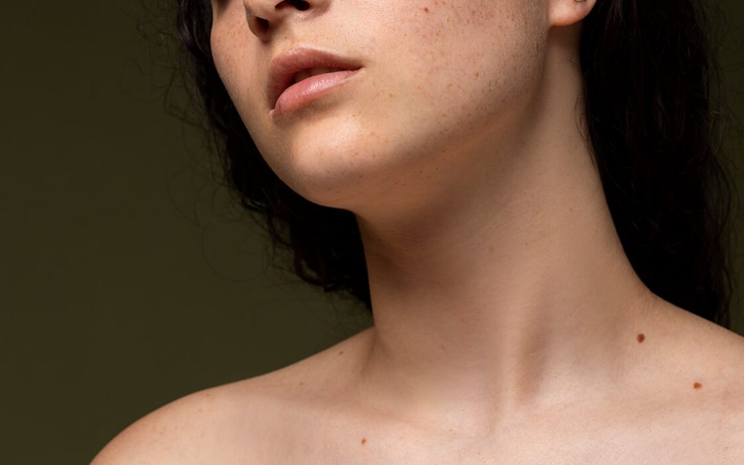 El cáncer de piel debe detectarse a tiempo con un autoexamen
